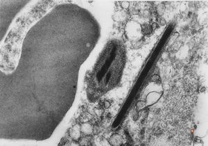 bone marrow - crystalloid inclusions Charcot-Leyden crystals formation